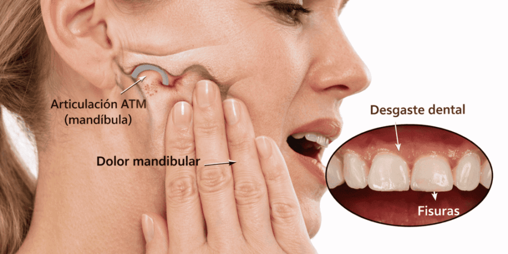 bruxismo en Sevilla con ferula de descarga para proteger los dientes